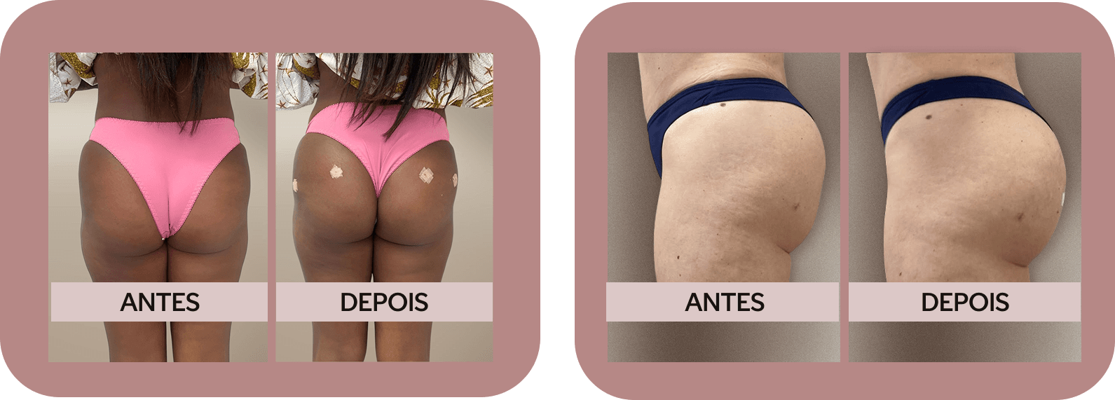 Imagem antes e depois do procedimento aumento de glúteos
