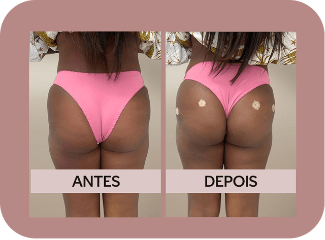 Antes e Depois