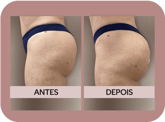 Antes e Depois