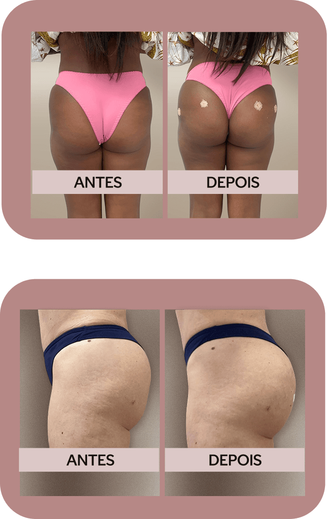 Imagem antes e depois do procedimento aumento de glúteos